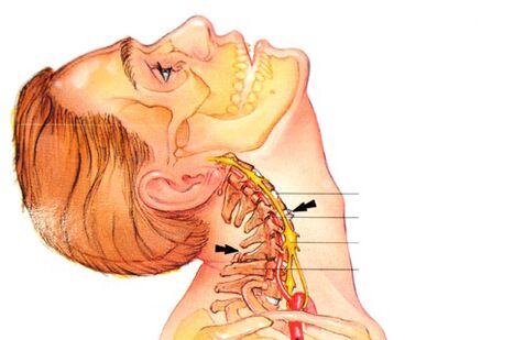 osteochondrosis ของกระดูกสันหลังส่วนคอมีลักษณะอย่างไร