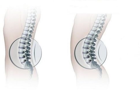 กระดูกสันหลังปกติและ lordosis เอวเพิ่มขึ้น