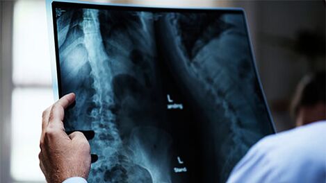 X-ray ของกระดูกสันหลังที่มี osteochondrosis